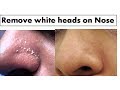 Turmeric to  remove white heads on nose starnaturalbeauties