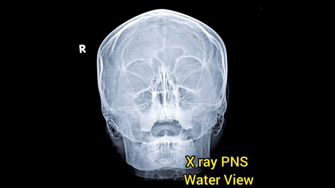 X Ray PNSWater ViewParanasal Sinus shortsvideo YouTube