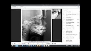 webceph, cephalometry with artificial intelligence