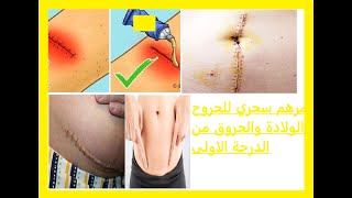 مرهم سحري لعلاج خياطة جرح الولادة والحروق/مجرب وفعال