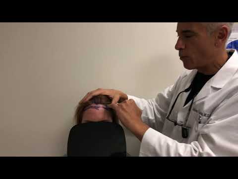 Hairline Lowering Surgery-