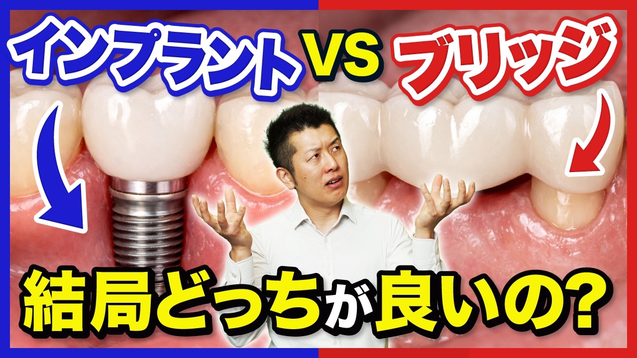 【業界のタブー】インプラントVSブリッジ論争の真実。世界のエビデンスが示す意外な結論とは?