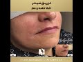 تزریق فیلر خط خنده و غم در شیراز توسط دکتر مهسا پور هاشمی