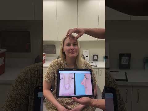 Video thumbnail: Tip Deformity Corrected | Anthony Bared MD, FACS | Miami, FL · Dr. Anthony Bared, M.D - Facial Plastic Surgeon