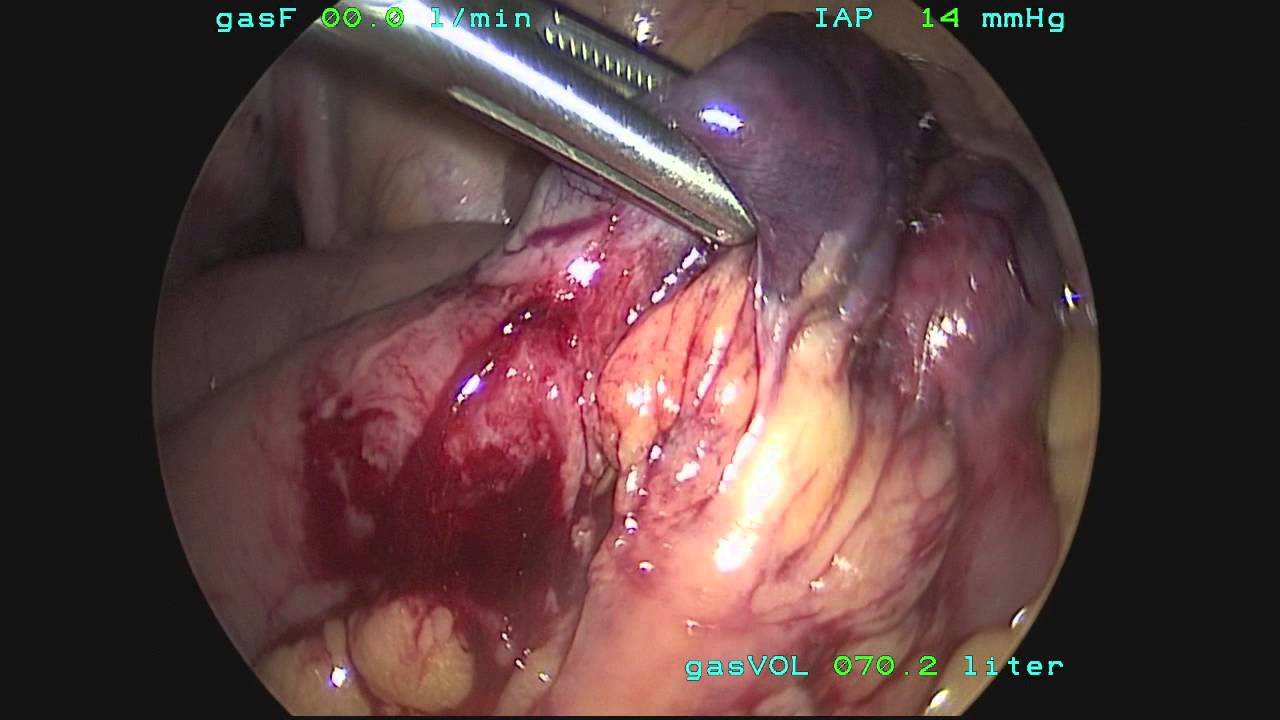 incarcerated hernia