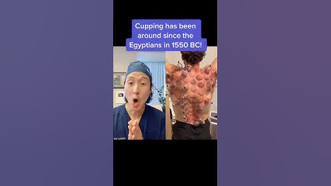 Extreme Cupping Therapy! #shorts #cupping