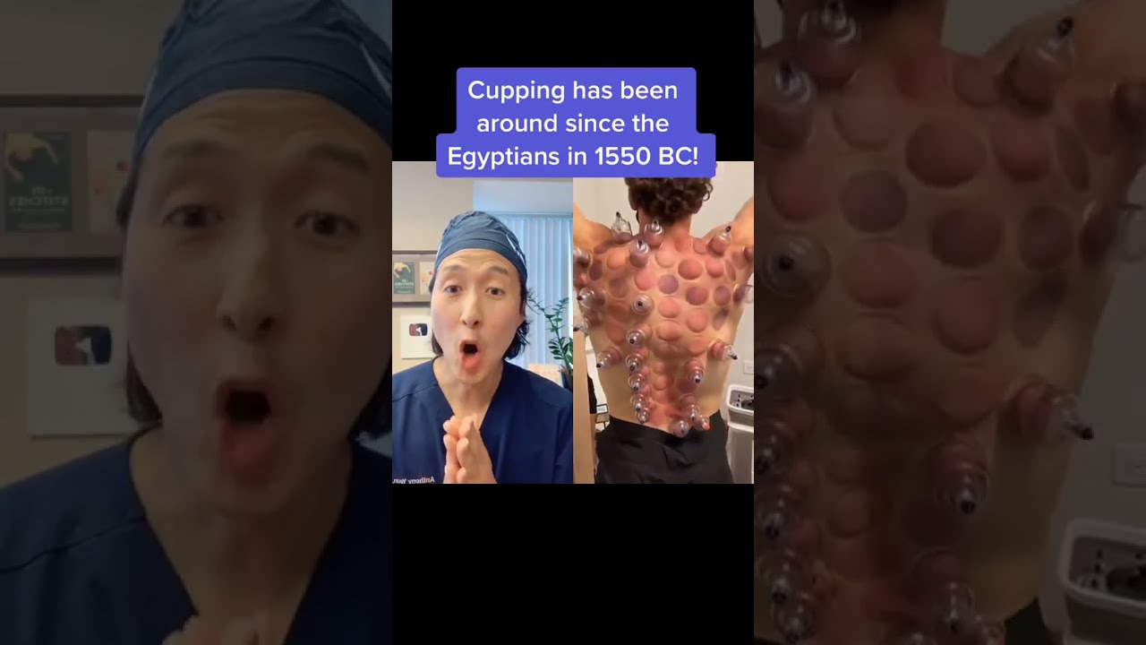 Extreme Cupping Therapy  shorts  cupping