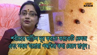 শরীরের আঁচিল দূর করতে কয়েকটি ভেষজ এবং সহজ ঘরোয়া পদ্ধতির কথা জেনে রাখুন। | EP 509