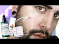 The Best Products To Fade Dark Spots / Post Inflammatory Hyperpigmentation  ✖  James Welsh