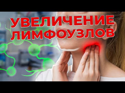 Почему увеличиваются ЛИМФОУЗЛЫ! Лимфоденопатия. Как оценить лимфоузлы самостоятельно.