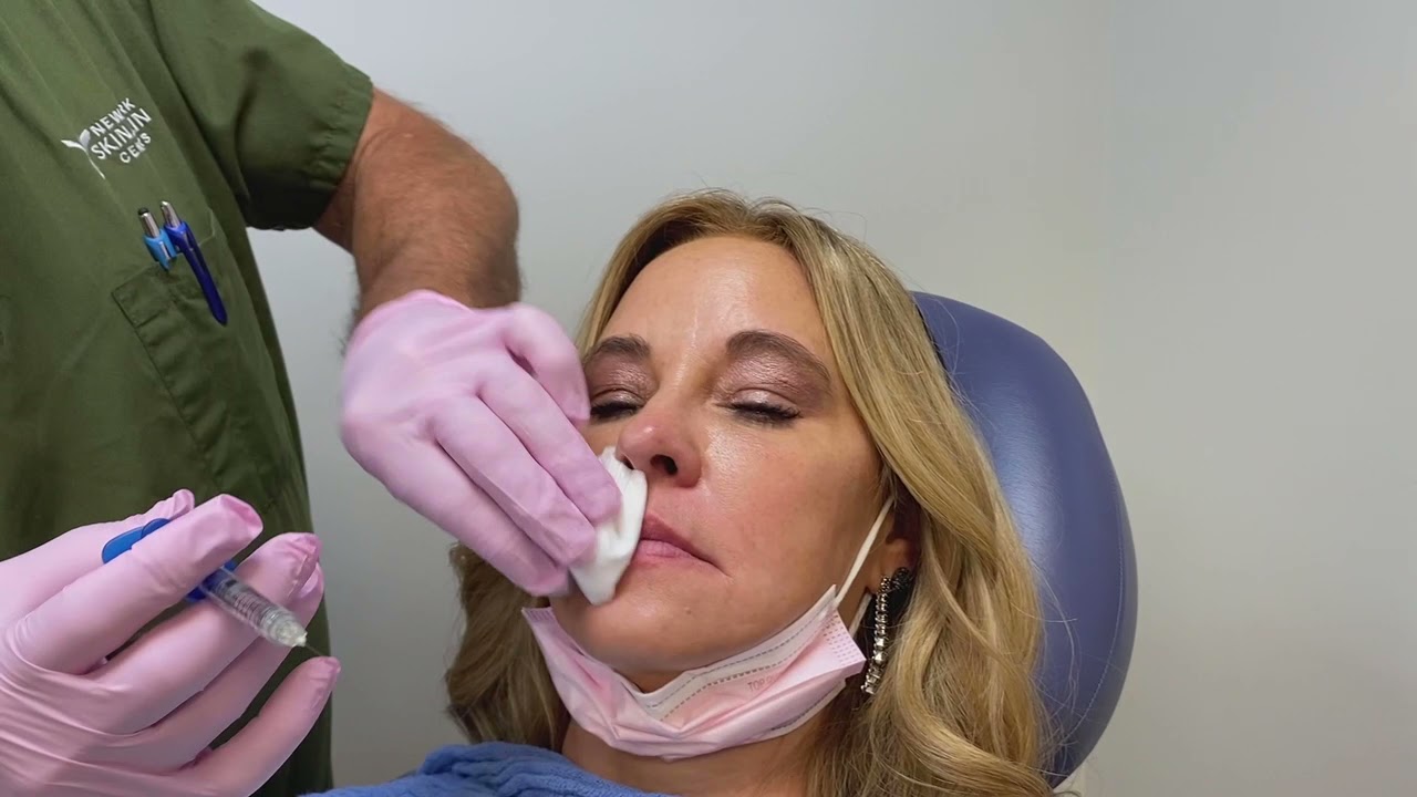 Lip restoration with the newest filler: RHA2