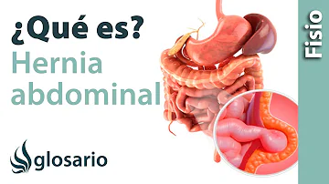 ¿Qué ocurre si te estalla una hernia en el estómago?