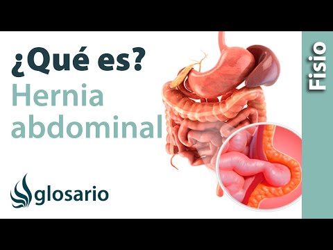 Vídeo: ❶ Síntomas Y Tratamiento De La Hernia