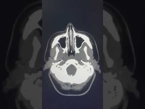 Venous Sinus Thrombosis- CT head and CT Venogram