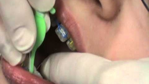 How to use flossfish - Flossing with braces