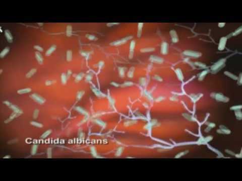 Vidéo: Qu'est-ce qui peut causer le Candida albicans?