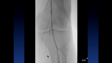 Retrograde SFA, Popliteal, and via Stent - Ehrin Armstrong, MD