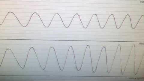 Minnesota Concussion Help- VNG smooth pursuit testing