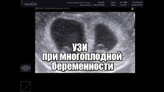 Многоплодная беременность на УЗИ. Близнецы.