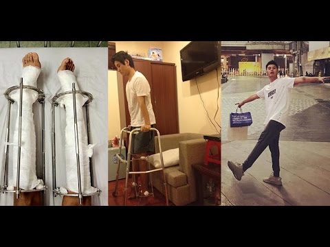 Video Kéo chân 9cm: Hot boy Hà Nội chia sẻ về 