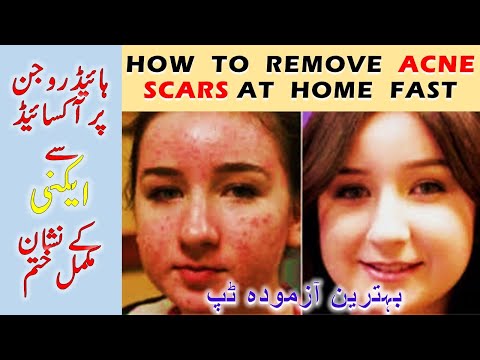 how to remove acne scars with hydrogen peroxide