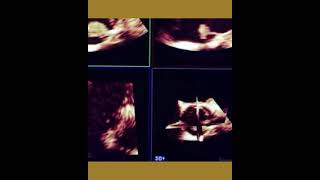 Libman-Sacks Endocarditis Lse Tee3D