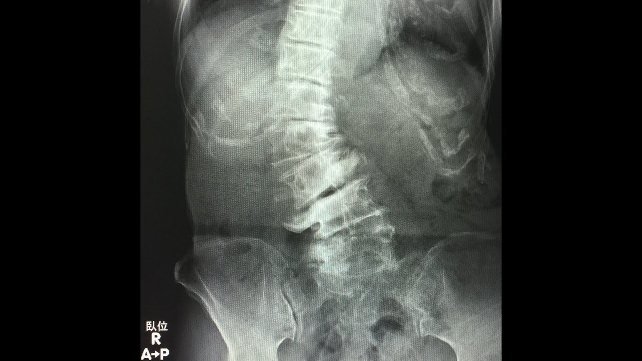 Epidural Catheter Placement for UKA by Dr.EpiCal (Scoliosis) YouTube