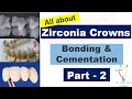 Zirconia crowns  cementation vs bonding