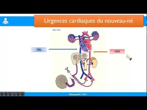 Vidéo: Analyse Coût-efficacité Du Dépistage Par Oxymétrie De Pouls Du Nouveau-né Pour Détecter Une Cardiopathie Congénitale Critique En Colombie