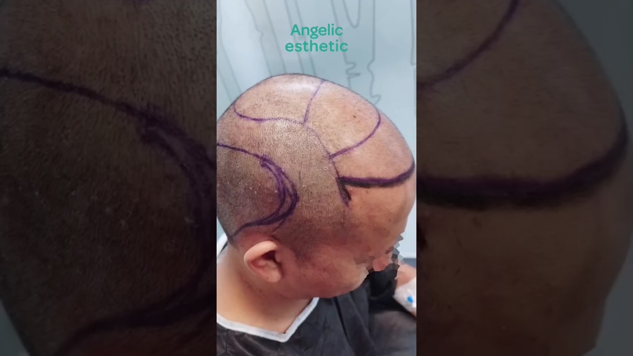 FUE Sapphire method Hair transplantation.