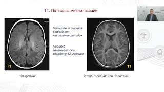 Развитие головного мозга по данным МРТ  Варианты нормы