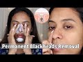 How I REMOVE BLACKHEADS/ BUMPS /DOTS PERMANENTLY from Nose Face - 2 EASY AND PAINLESS METHOD