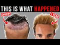 I Got A Hair Transplant In Turkey **& this is what it looked like 12 months later**