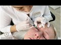 МЕЗОТЕРАПИЯ ОБЛАСТИ ВОКРУГ ГЛАЗ ПРЕПАРАТОМ DERMAHEAL