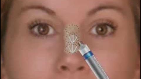 Mô phỏng 3D Nâng Mũi Không Phẫu Thuật Bằng Filler | Bệnh Viện Thẩm Mỹ Việt Mỹ