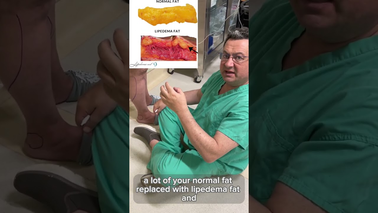 Complete Fat Removal During Lipedema Surgery: Is it Good or Bad? - Dr. Boris Volshteyn
