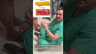Complete Fat Removal During Lipedema Surgery Is It Good Or Bad? - Dr. Boris Volshteyn