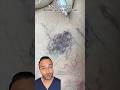 Removing Spider Veins With Sclerotherapy Treatments Dr Somji Explains Removing Spider Veins With Sclerotherapy Treatments Dr Somji Explains