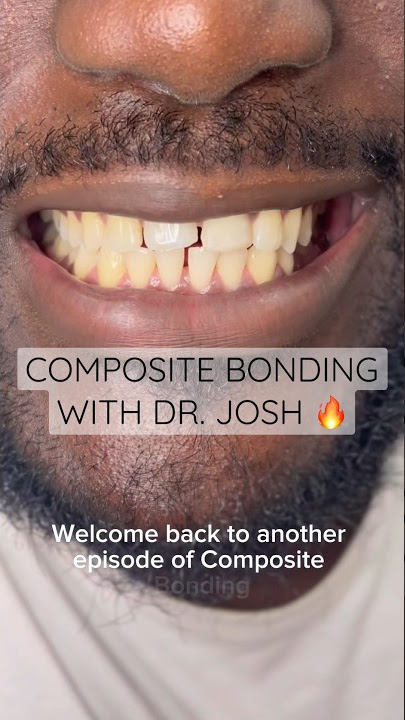 Composite bonding in London Ontario - Sbenati Dentistry