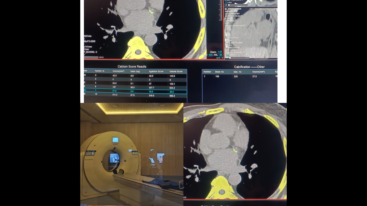 Оценка коронарного кальция по данным United Imaging, 160 срезов, постобработка и видеосъемка