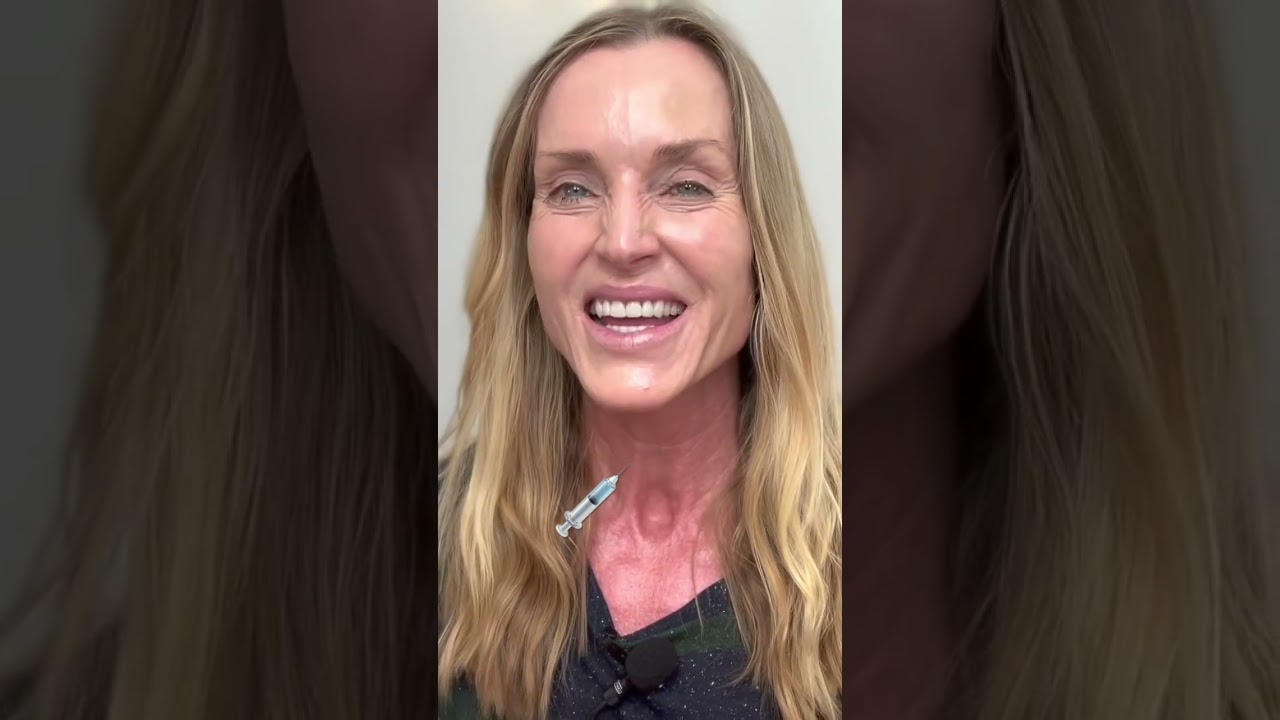 Is Sculptra worth the $? My 1 year Sculptra Results