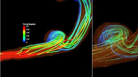 flow simulation around realistic aneurysm model