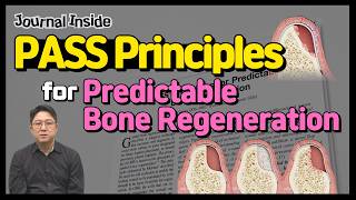 [Journal Inside] “PASS” Principles for Predictable Bone Regeneration (AI Voice-over)