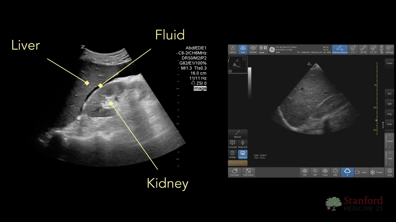 Point Of Care Ultrasound For Ascites Pocus Youtube