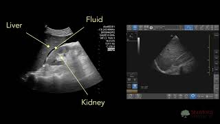 Point of Care Ultrasound for Ascites (POCUS)