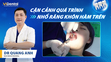 Cận Cảnh Quy Trình Nhổ 2 Răng Khôn Hàm Trên Mọc Lệch, Sâu, Vỡ | DR Quang Anh