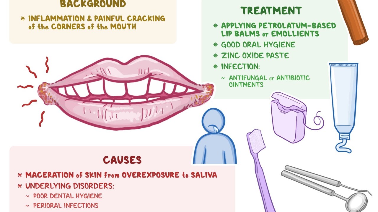 Angular cheilitis How to Recover and prevent! #angularchelitis #candida ...