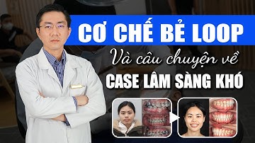 Niềng Răng Ca Khó - Cơ Chế Bẻ Loop Khi Niềng Răng Tại Vinalign | Nam Bùi Vinalign