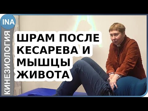 Влияние шрама от кесарево на мышцы живота. Как убрать живот? Васильева кинезиоология