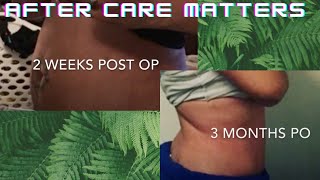 Smart Lipo Aftercare *What They Dont Tell You Can Make or Break Your Results*